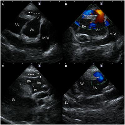 Case report: Imaging features of aorta-right atrial tunnel in a dog using two-dimensional echocardiography and computed tomography